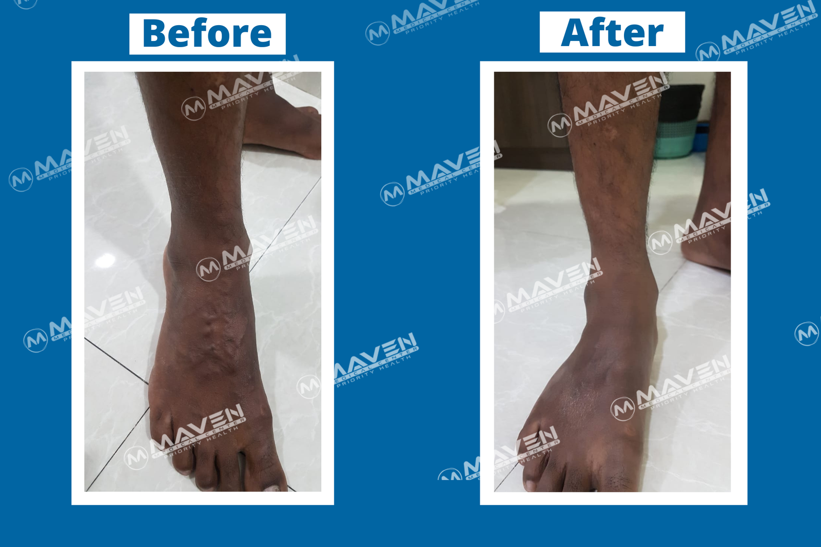 Varicose Veins Before After Photos